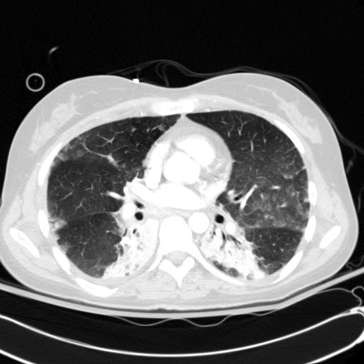 Acute myocardial infarction in CT (Radiopaedia 39947-42415 Axial lung window 67).jpg