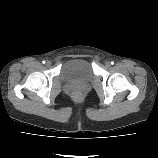 Acute myocarditis (Radiopaedia 55988-62613 Axial C+ portal venous phase 79).jpg