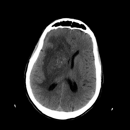 File:Acute necrotizing toxoplasma encephalitis (Radiopaedia 10683-11150 Axial non-contrast 16).jpg
