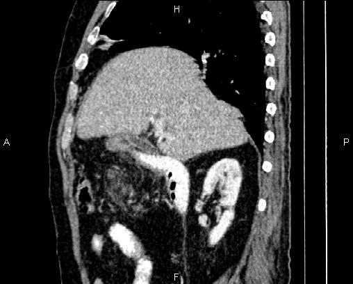 Acute pancreatitis (Radiopaedia 85146-100701 Sagittal C+ portal venous phase 27).jpg