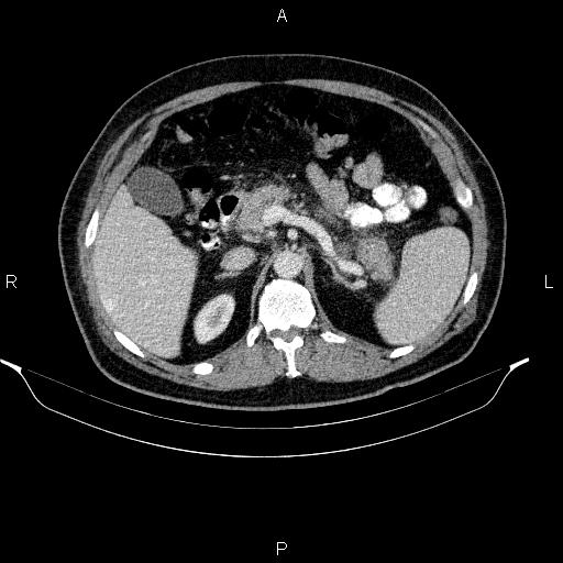 File:Acute pancreatitis (Radiopaedia 85390-101010 Axial C+ portal venous phase 34).jpg