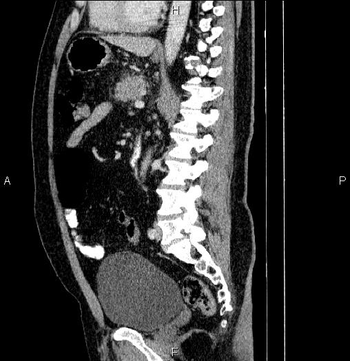 File:Acute pancreatitis (Radiopaedia 85390-101010 Sagittal C+ portal venous phase 58).jpg