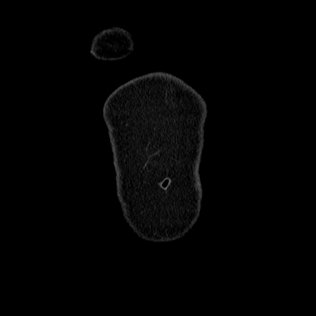 Acute pancreatitis - Balthazar C (Radiopaedia 26569-26714 Coronal C+ portal venous phase 4).jpg