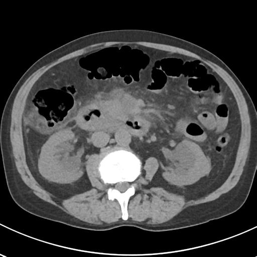 File:Acute pancreatitis and walled-off necrosis (Radiopaedia 29888-30404 Axial non-contrast 36).jpg