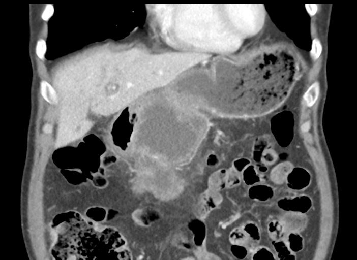 Acute pancreatitis and walled-off necrosis (Radiopaedia 29888-30404 Coronal C+ portal venous phase 16).jpg