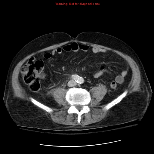 File:Acute pancreatitis with incidental pancreatic lipoma (Radiopaedia 10190-10730 Axial C+ portal venous phase 49).jpg