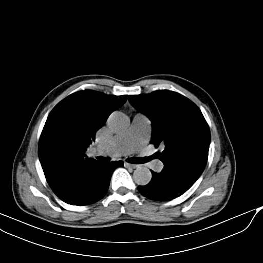 File:Acute pulmonary embolism (Radiopaedia 69510-79390 Axial non-contrast 3).jpg