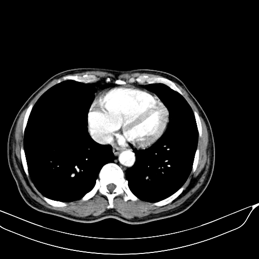 Acute pulmonary embolism (Radiopaedia 69510-79390 D 64).jpg