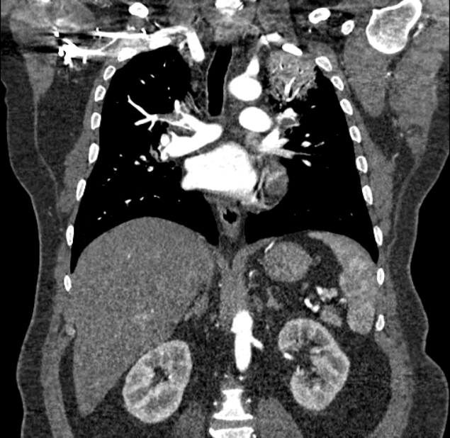 Acute pulmonary embolism with pulmonary infarcts (Radiopaedia 77688-89908 Coronal C+ CTPA 52).jpg