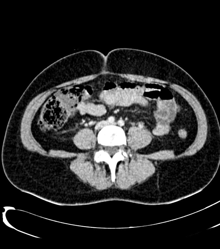 Acute pyelonephritis (Radiopaedia 40264-42816 Axial C+ portal venous phase 45).jpg