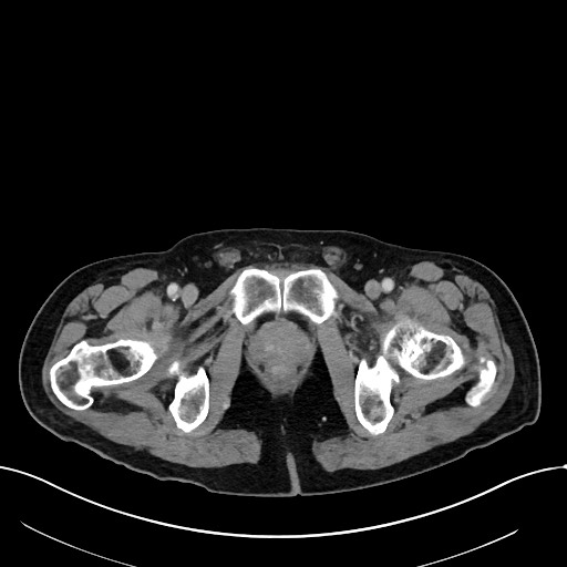 Acute renal infarction (Radiopaedia 59375-66736 Axial C+ portal venous phase 121).jpg