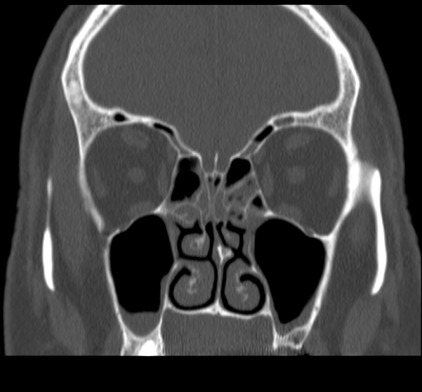 Acute sinusitis (Radiopaedia 23161-23215 Coronal bone window 35).jpg