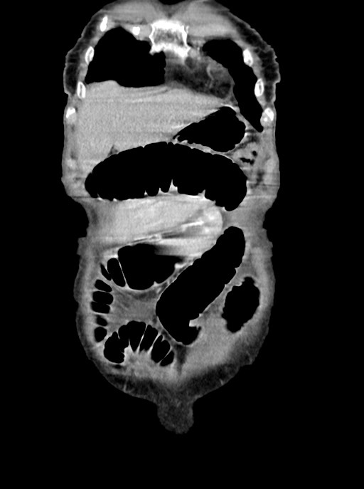 Acute small bowel (ileal) volvulus (Radiopaedia 71740-82139 Coronal C+ portal venous phase 18).jpg