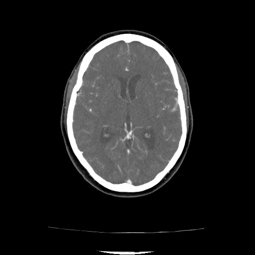 Acute subarachnoid hemorrhage and accessory anterior cerebral artery (Radiopaedia 69231-79009 Axial C+ arterial phase 99).jpg