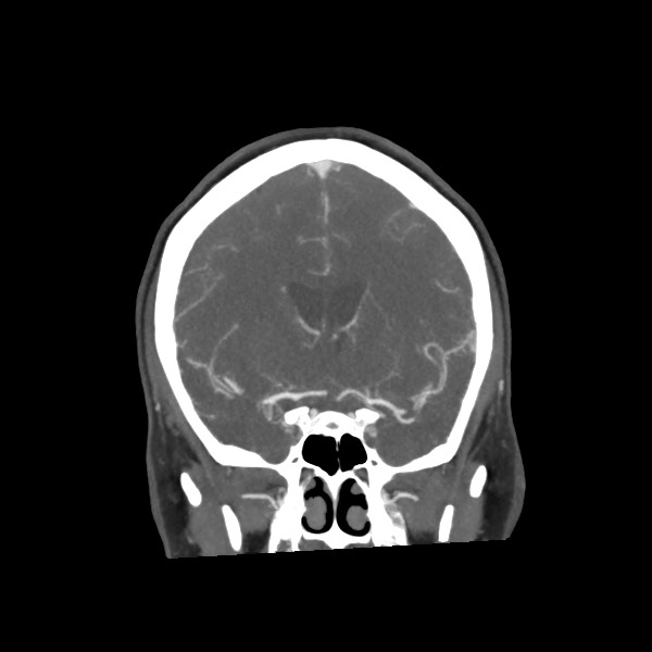 Acute subarachnoid hemorrhage and accessory anterior cerebral artery (Radiopaedia 69231-79009 Coronal C+ arterial phase 35).jpg