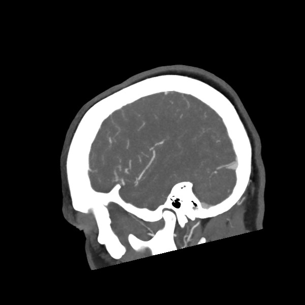 Acute subarachnoid hemorrhage and accessory anterior cerebral artery (Radiopaedia 69231-79009 Sagittal C+ arterial phase 18).jpg