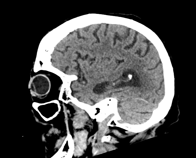 Acute traumatic subdural hematoma (Radiopaedia 82921-97257 Sagittal non-contrast 52).jpg