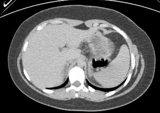 Acute unilateral nonhemorrhagic adrenal infarction (Radiopaedia 67560-76957 Axial renal excretory phase 15).jpg