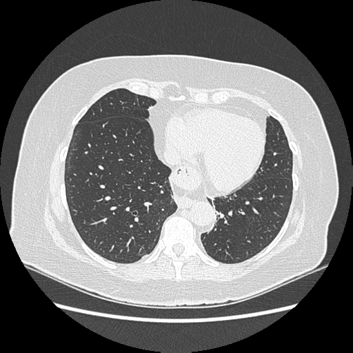 Adenocarcinoma in situ of lung (Radiopaedia 38685-40829 B 158).png
