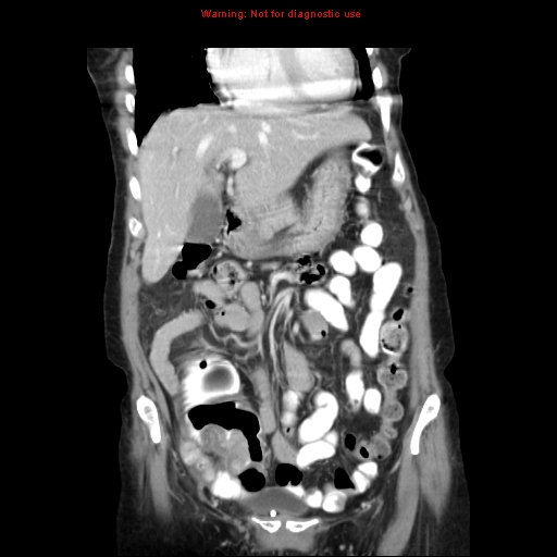 File:Adenocarcinoma of the colon (Radiopaedia 8191-9039 Coronal liver window 15).jpg