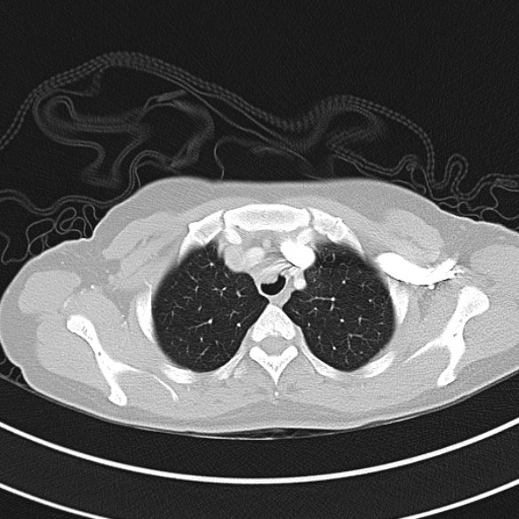 Adenocystic carcinoma of the trachea (Radiopaedia 47677-52525 Axial lung window 35).jpg