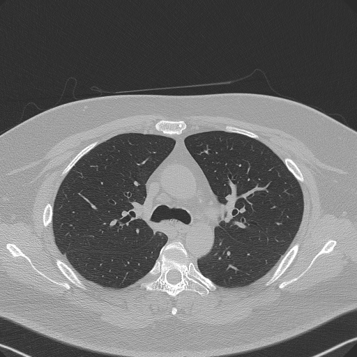 Adenoid cystic carcinoma of the trachea (Radiopaedia 49042-54137 Axial lung window 120).jpg