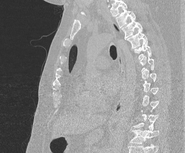 File:Adenoid cystic carcinoma of the trachea (Radiopaedia 49042-54137 Sagittal lung window 257).jpg
