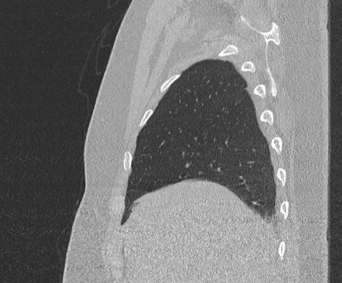 Adenoid cystic carcinoma of the trachea (Radiopaedia 49042-54137 Sagittal lung window 84).jpg