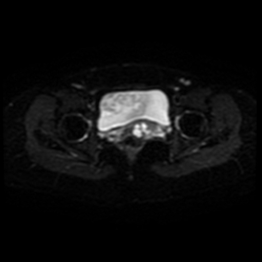 Adenoma malignum of cervix (Radiopaedia 66441-75705 Axial DWI 16).jpg