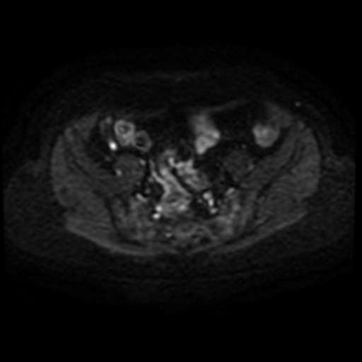 Adenoma malignum of cervix (Radiopaedia 66441-75705 Axial DWI 28).jpg