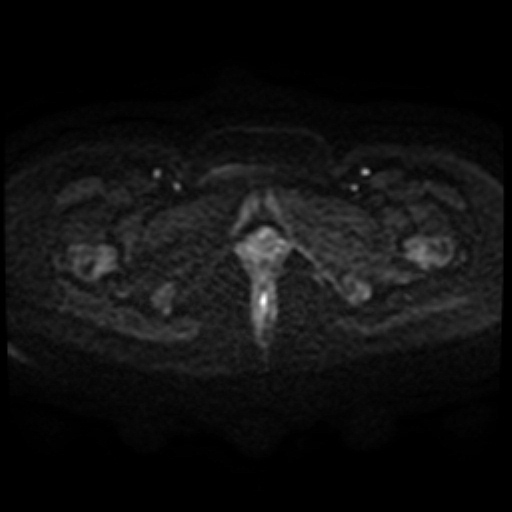 File:Adenoma malignum of cervix (Radiopaedia 66441-75705 Axial DWI 99).jpg