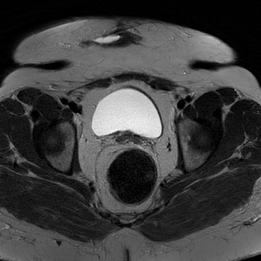 File:Adenomyosis within a didelphys uterus (Radiopaedia 70175-80215 Axial T2 24).jpg