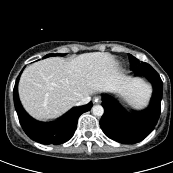 Adhesional small bowel obstruction (Radiopaedia 48397-53305 Axial C+ portal venous phase 5).jpg