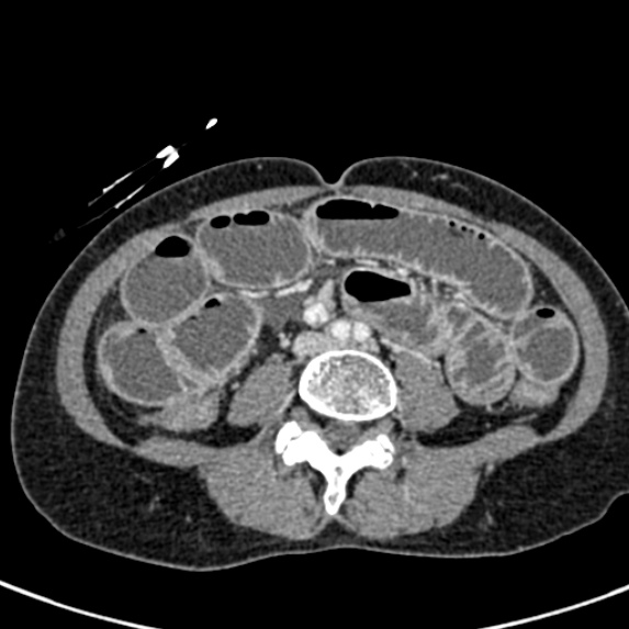 Adhesional small bowel obstruction (Radiopaedia 48397-53305 Axial C+ portal venous phase 52).jpg