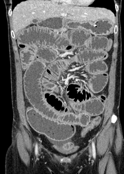 Adhesional small bowel obstruction (Radiopaedia 48397-53305 Coronal C+ portal venous phase 116).jpg