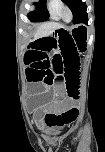 Adhesional small bowel obstruction (Radiopaedia 52107-57980 Coronal C+ portal venous phase 15).jpg