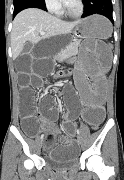 Adhesional small bowel obstruction (Radiopaedia 52107-57980 Coronal C+ portal venous phase 34).jpg