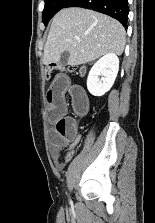 Adhesional small bowel obstruction (Radiopaedia 58900-66131 Sagittal C+ portal venous phase 67).jpg