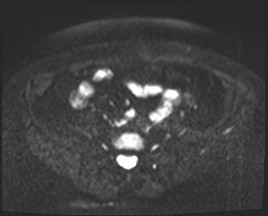 File:Adnexal multilocular cyst (O-RADS US 3- O-RADS MRI 3) (Radiopaedia 87426-103754 Axial DWI 1).jpg