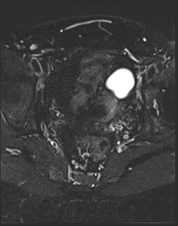 File:Adnexal multilocular cyst (O-RADS US 3- O-RADS MRI 3) (Radiopaedia 87426-103754 Axial T2 fat sat 15).jpg