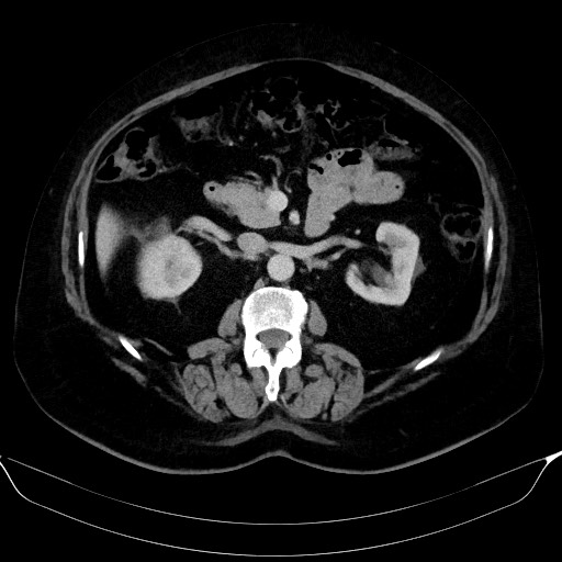 Adrenal cortical carcinoma (Radiopaedia 64017-72769 Axial C+ portal venous phase 28).jpg