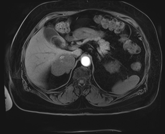 File:Adrenal cortical carcinoma (Radiopaedia 64017-72770 Axial T1 C+ fat sat 7).jpg