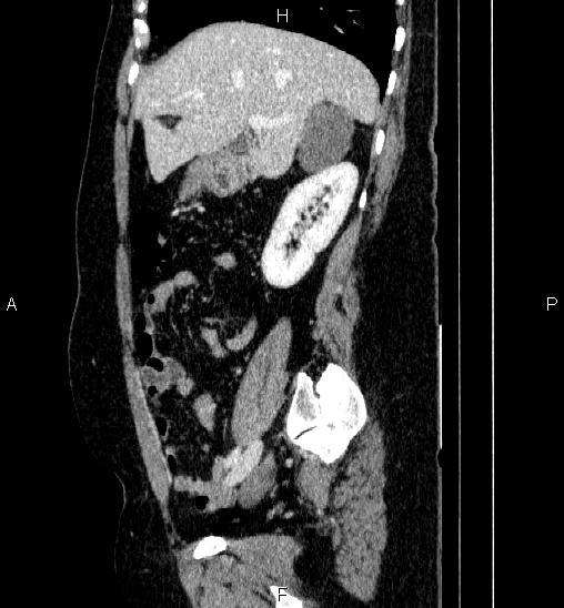 Adrenal cortical carcinoma (Radiopaedia 84882-100379 Sagittal C+ portal venous phase 29).jpg