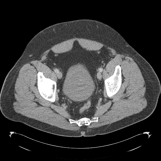 File:Adrenal cyst (Radiopaedia 45625-49776 Axial C+ portal venous phase 86).png