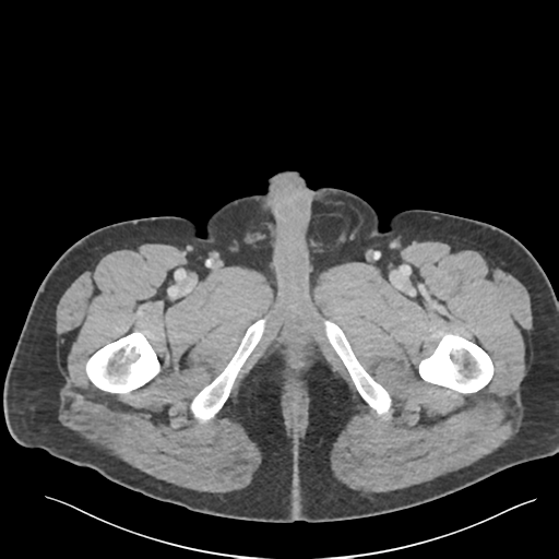 Adrenal cyst (Radiopaedia 45625-49777 Axial C+ portal venous phase 110).png