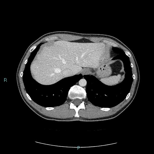 Adrenal cystic lymphangioma (Radiopaedia 83161-97534 Axial C+ portal venous phase 16).jpg