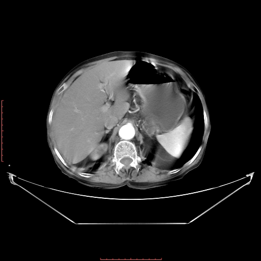 Adrenal hemangioma (Radiopaedia 68923-78668 Axial C+ arterial phase 24).jpg