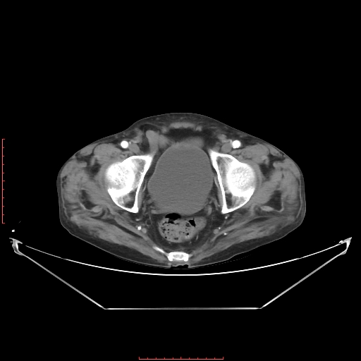 File:Adrenal hemangioma (Radiopaedia 68923-78668 Axial C+ arterial phase 67).jpg