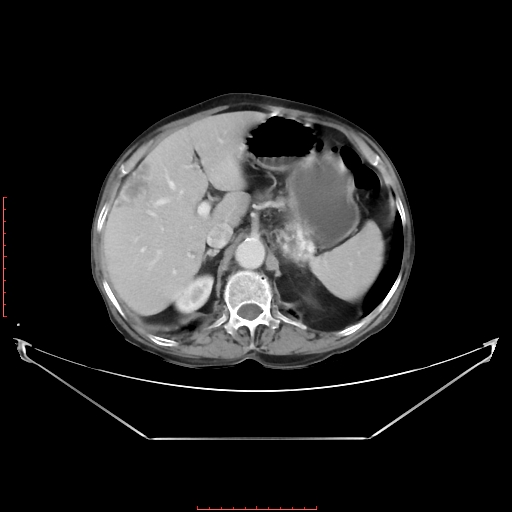 Adrenal hemangioma (Radiopaedia 68923-78668 Axial C+ portal venous phase 23).jpg
