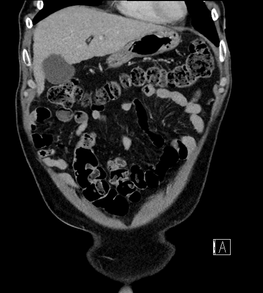 Adrenal lymphoma (Radiopaedia 73730-84529 Coronal C+ portal venous phase 19).jpg